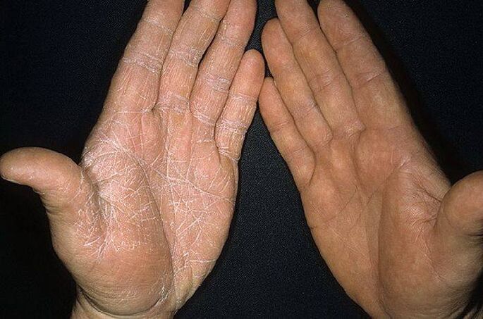 συμπτώματα ενός μύκητα στο δέρμα των χεριών