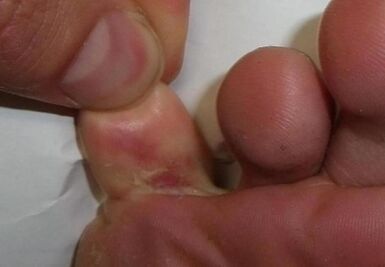 μια ρωγμή στα δάχτυλα των ποδιών είναι αποτέλεσμα μόλυνσης από μύκητα